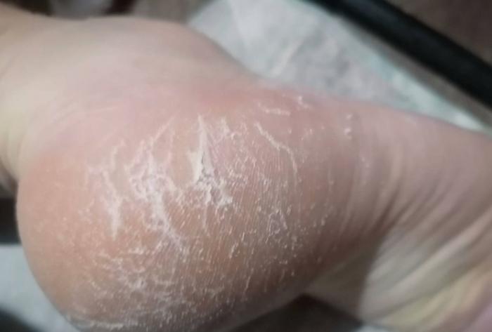腳底死皮預防 腳底死皮預防