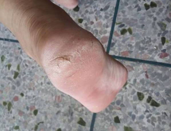 腳底死皮預防 腳底死皮預防