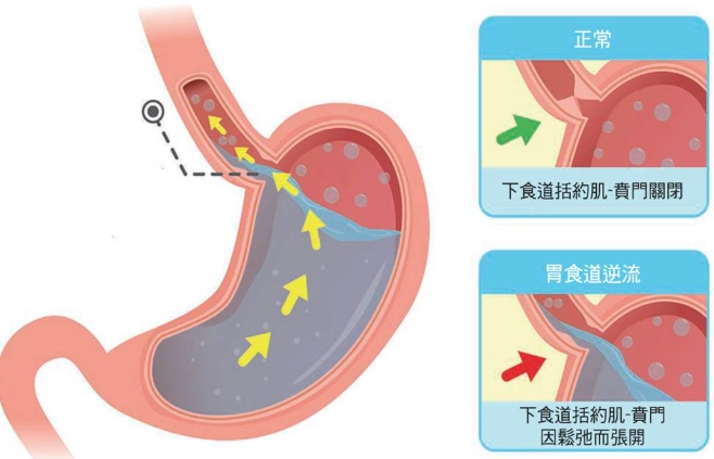 中醫逆流症狀 中醫逆流症狀