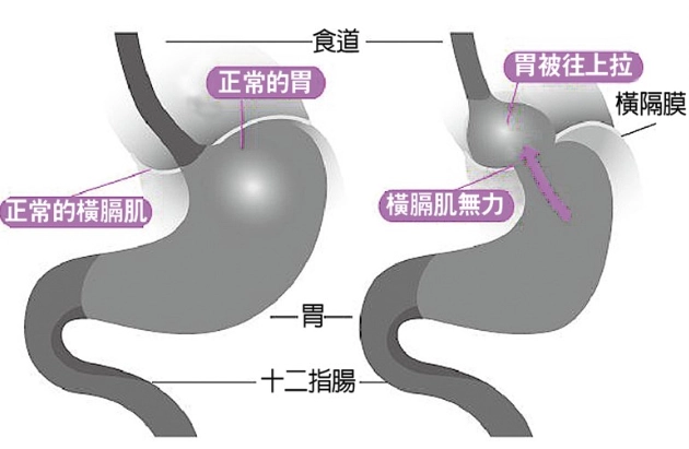 胃食道逆流中醫治療 胃食道逆流中醫治療