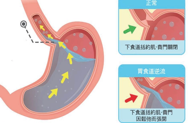 中醫治胃食道逆流 中醫治胃食道逆流
