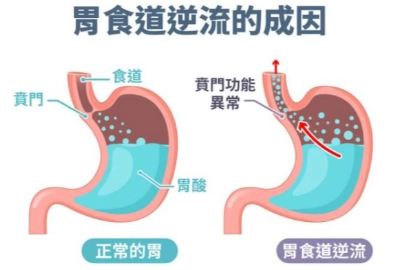 胃食道逆流中醫治療 胃食道逆流中醫治療