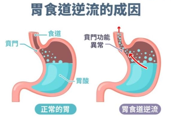 胃食道逆流中醫治療 胃食道逆流中醫治療