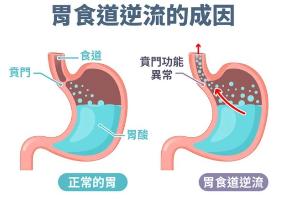 半夏瀉心湯 胃食道逆流 半夏瀉心湯 胃食道逆流