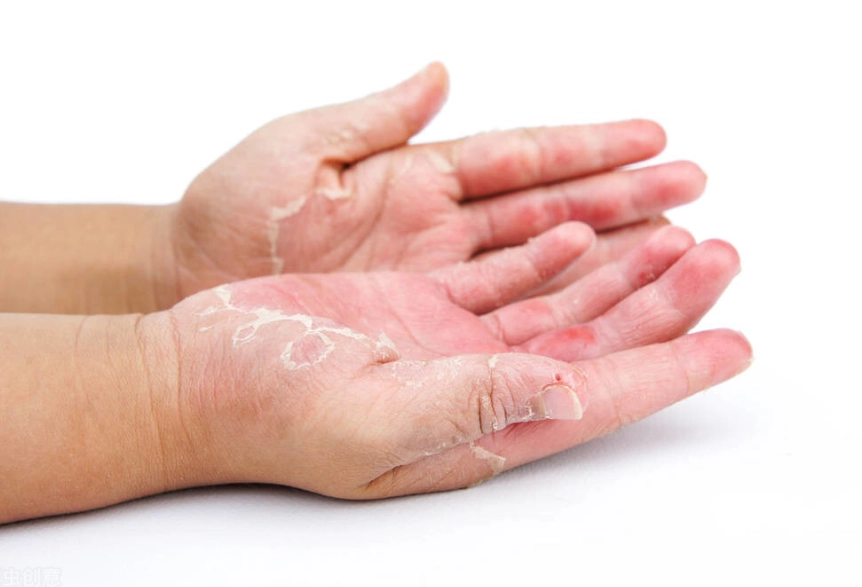 手脫皮原因 手脫皮原因