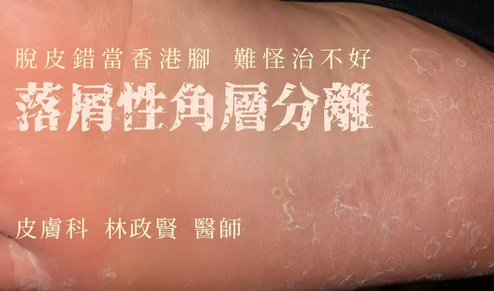 皮膚乾燥脫屑 皮膚乾燥脫屑